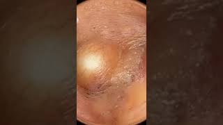 Pimple Removal Behind Ear #oddlysatisfying #sick #blackhead #pimplepopper #satisfying #cyst #omg