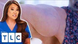 Dr Lee Removes Big Lump That’s Been On A Woman’s Arm Since The 80s | Dr Pimple Popper | CENSORED