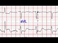 ecg ekg case review 74 y o female that had been having chest pain nausea and vomiting.