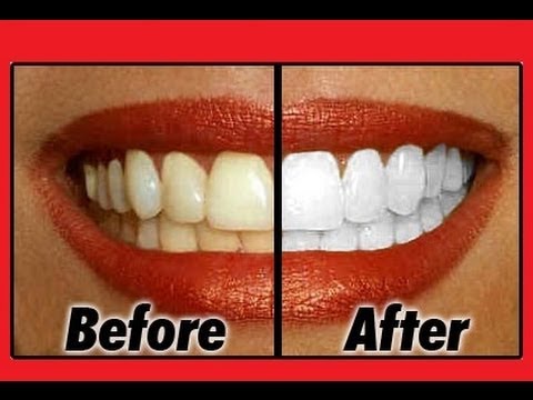 How To Whiten Your Teeth Fast And Naturally At Home - YouTube