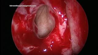 CSF Leak repair Video 8 -  Dissection of the Frontal Sinus