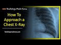 Chest X Ray  : Interpretation for Medical Students and Doctors