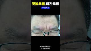 미간주름😩귀주름(귓볼주름) 팔자주름, 루이빈치과에 온 치매 뇌졸중 파킨슨병 경동맥협착 뇌압안압 어지럼증 난청 가슴답답 부정맥 증상, 심장질환자의 주름 I #루이빈치과 류지헌 원장