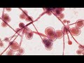 Colorado has 1 case of Candida auris