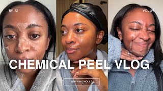 CHEMICAL PEEL FULL PROCESS BEFORE \u0026 AFTER | HYPERPIGMENTATION/ACNE ON BLACK SKIN | THE PERFECT PEEL