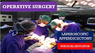 LAPAROSCOPIC APPENDICECTOMY- STEP BY STEP Operative Surgery