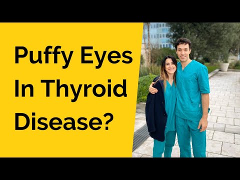 Does hyperthyroidism cause periorbital edema?