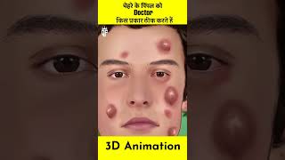 कीड़े वाले Pimple 3D Animation 😳 #shorts #short #knowledge #shortvideo #viralshort