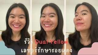 รีวิวเลเซอร์ dual yellow รักษารอยแดง