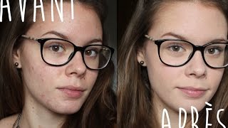 Routine teint peau acnéique, à imperfections, mixte à grasse !