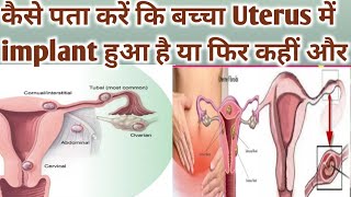 कैसे पता करें कि बच्चा Uterus में implant हुआ है या नहीं ।Early Pregnancy Symptoms।Implantation।