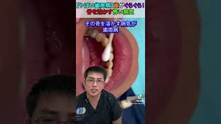 【やばい歯周病】歯がぐらぐら！骨を溶かす怖い病気