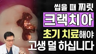 골드인레이 했던 어금니 통증+씹을때도 불편해요ㅠㅠ 큐레이펜 진단해보니 크랙치아 🤦‍♂️ 증상까지 있다면 초기에 치료해야 최소한으로 치료합니다. 주변치아도 정기검진 필수!