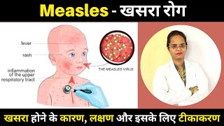 खसरा रोग क्या है? कारण, लक्षण, इलाज, घरेलु उपाय - सब जाने | Measles Meaning in Hindi | Pooja Banjara