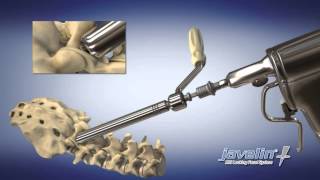 The Javelin MIS Locking Facet System