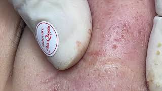 |398| Blackheads & Acne treatment 19/10/2021