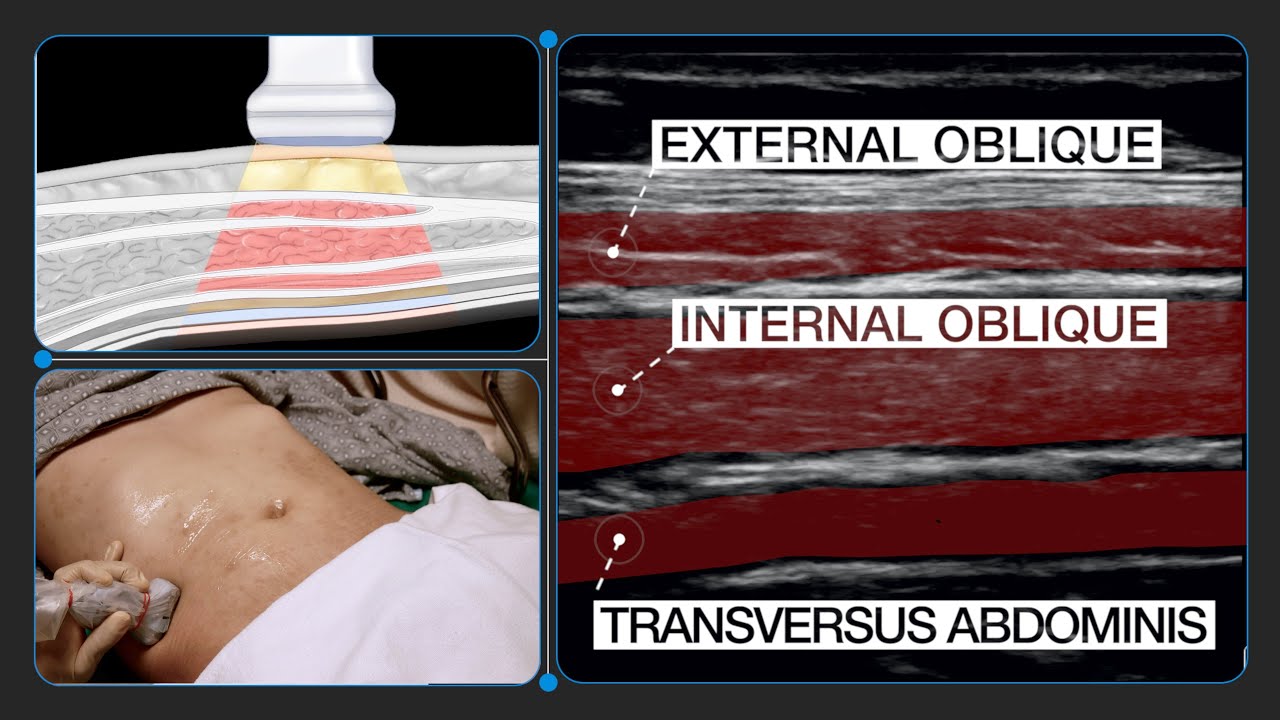 How To Correctly Identify Anatomy For Transversus Abdominis Plane (TAP ...