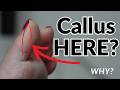 Callus of the Big Toe