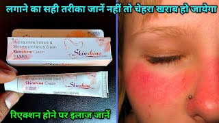 क्यों इस क्रीम से चेहरा खराब हो जाता है? | skinshine cream uses in hindi, skinshine cream how to use