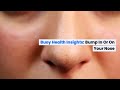 Bump in or on Your Nose: Common Causes and When to Seek Medical Care | BuoyHealth.com