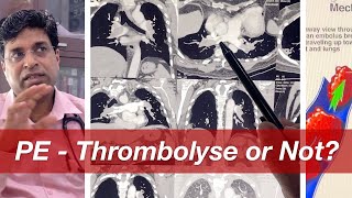 #icucase 11: Pulmonary Embolism - Thrombolyse or not?