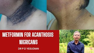 Oral metformin for acanthosis nigricans