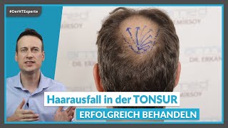 Haartransplantation in der TONSUR: So funktioniert die Behandlung für kahle Stellen am Hinterkopf