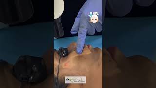 Carbon Facial for treating oily, acne prone skin by Dr Sonia #carbonfacial #acne #carbonpeel #glowup