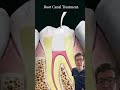 doctor explains root canal treatment shorts dental