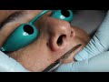 must watch dermaplane with pro tips