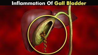 Cholecystitis (Gallbladder Inflammation) | Symptoms, Causes and Treatment (Urdu/Hindi)