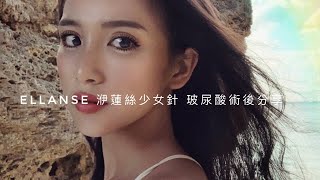 淚溝填充洢蓮絲少女針+玻尿酸術後分享|Beauty