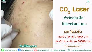 Review Co2 Laser กำจัดกระเนื้อ ให้ผิวหน้าเรียบเนียน ที่กัญวราคลินิก