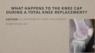The kneecap in total knees - What happens to the kneecap during a total knee replacment?