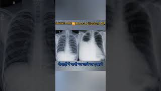 Diffrence between Normal Chest X ray \u0026Pleural effusion #medicalimaging #xray #radiology