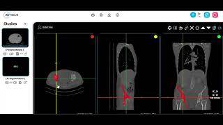 Hip Auto Segmentation