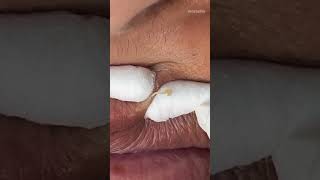 How lip blackheads are extracted #blackheaads #skincare #skin #selfcare