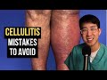 How to Treat Cellulitis (Common Mistakes to Avoid)