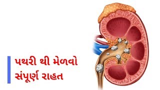 Informative Sunday 22 | પથરી થી મેળવો સંપૂર્ણ રાહત | Get Full Relief From Stones