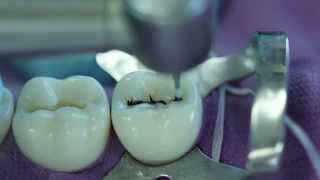 Class I Preparation for Amalgam 37 O