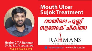 വായിലെ പുണ്ണ്:സുജോക് ചികിത്സ Mouth Ulcer Su Jok Treatment Method Acupuncture Malayalam Healer Rahman