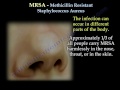 mrsa methicillin resistant saphylococcus aureus everything you need to know dr. nabil ebraheim