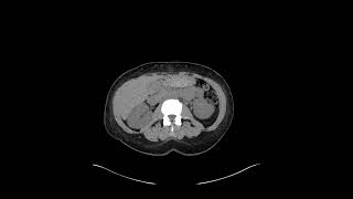 Xanthogranulomatous Pyelonephritis #1