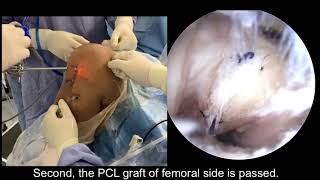 The Transportal Graft Passage in Transtibial Posterior Cruciate Ligament Reconstruction...