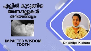 wisdom tooth impaction || എല്ലിൽ കുടുങ്ങിയ അണപ്പല്ലുകൾ ഉണ്ടാക്കുന്ന പ്രശ്നങ്ങൾ, പരിഹാരങ്ങൾ