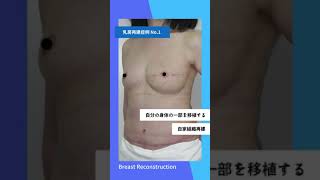 乳房再建 症例紹介 01 【形成外科医 矢島和宜】