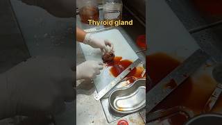 Cystic thyroid gland gross pathology