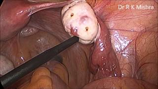 Laparoscopic Ovarian Drilling by Dr. R.K. Mishra