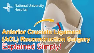 Anterior Cruciate Ligament (ACL) Reconstruction Surgery - Explained