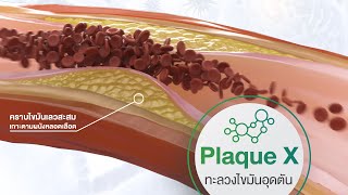 กำจัดไขมันอุดตันในหลอดเลือด ด้วย Plaque X ที่ Healing Art Vascular